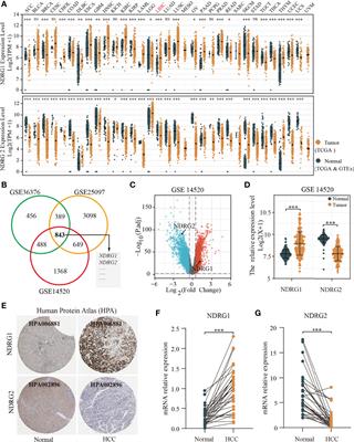 Clinical Diagnostic and Prognostic Potential of NDRG1 and NDRG2 in Hepatocellular Carcinoma Patients